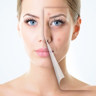 Laser Scar Removal Cost in Dubai