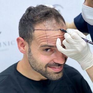 1 Dirham Hair Transplant in Dubai