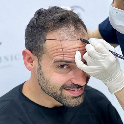 1 Dirham Hair Transplant in Dubai