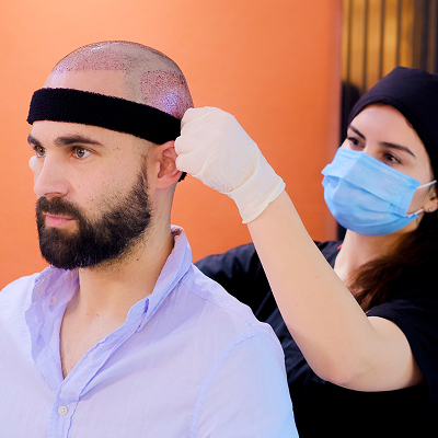 FUE Hair Transplant Cost In Dubai