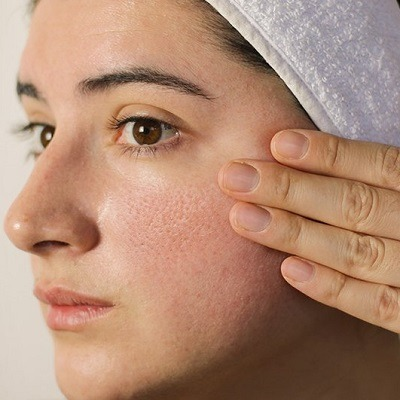 Large Pores Treatment Cost In Dubai