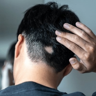 Alopecia Areata Treatment Cost in Dubai & Abu Dhabi