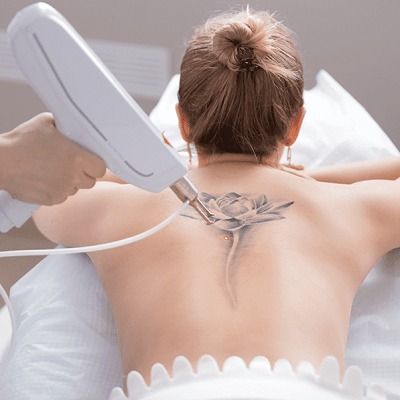 Laser Tattoo Removal Cost in Dubai