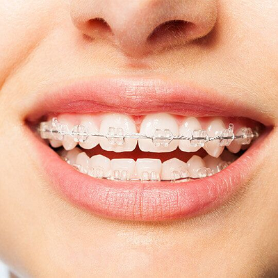 Orthodontists Cost in Dubai