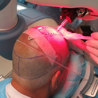Robotic Hair Transplant Cost In Dubai & Abu Dhabi